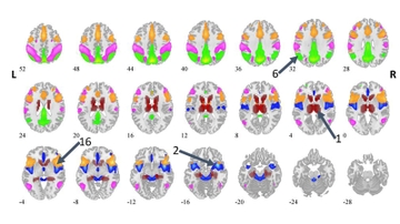 Brain-scan data discovery could revolutionize treatment of bipolar disorder & depression