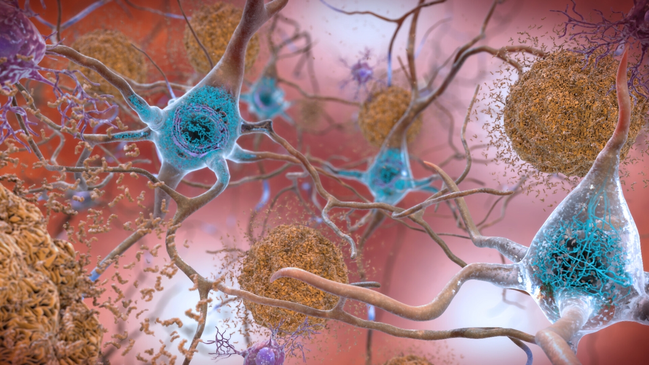 In the Alzheimer’s affected brain, 