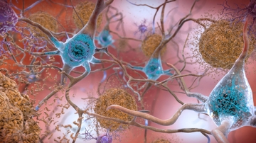 Early detection of brain degeneration on the horizon with innovative sensor