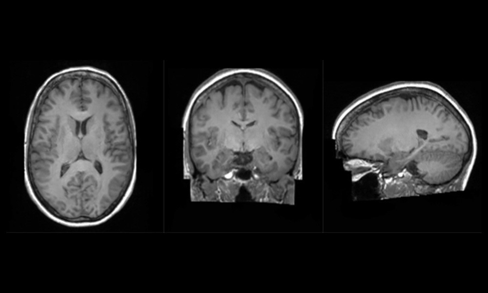 Brain scans performed by King's College London
