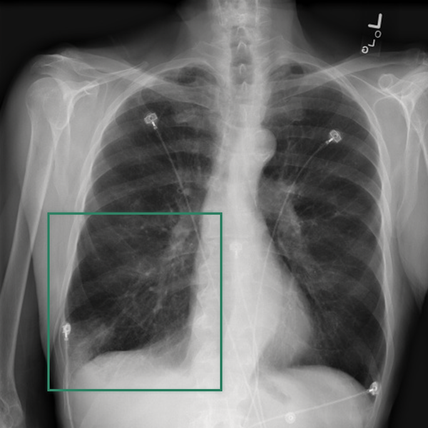 Medical AI Reasoning