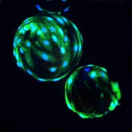 Stroke stem cell therapy