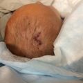 Hydrocephalus: ETV Incision