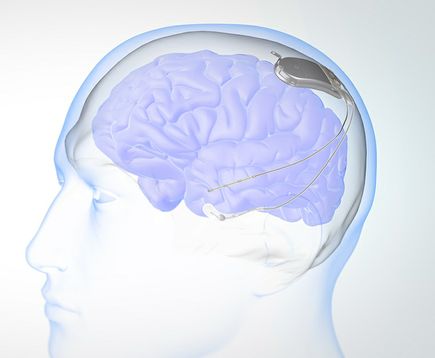 Responsive Neurostimulation System illustration