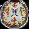 Slowing MS brain shrinkage