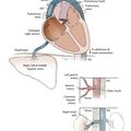 Situs inversus with levocardia