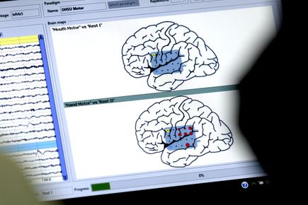 Awake craniotomy with language mapping
