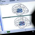 Awake craniotomy with language mapping