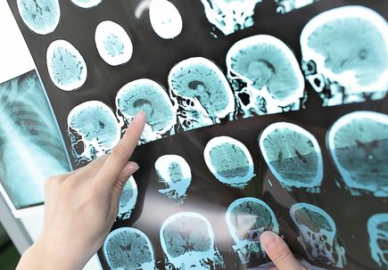 Stroke care dwindles worldwide during pandemic, study finds