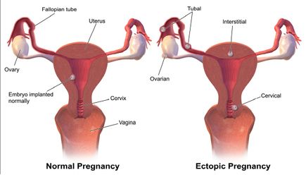 Normal vs Ectopic Pregnancy