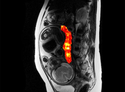 OHSU Placenta Research - Placenta MRI