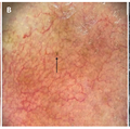 Finding melanoma