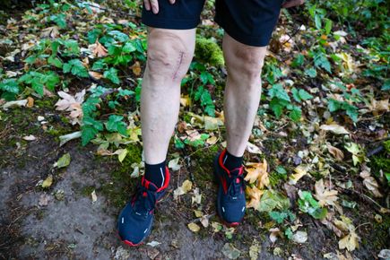 OHSU patient after receiving and implantable shock absorber