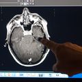 OHSU patient is world’s first documented case of brain disease from fentanyl inhalation