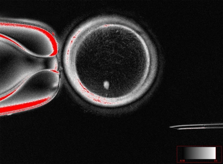 A new technique to treat infertility