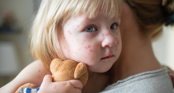 Getty Rash