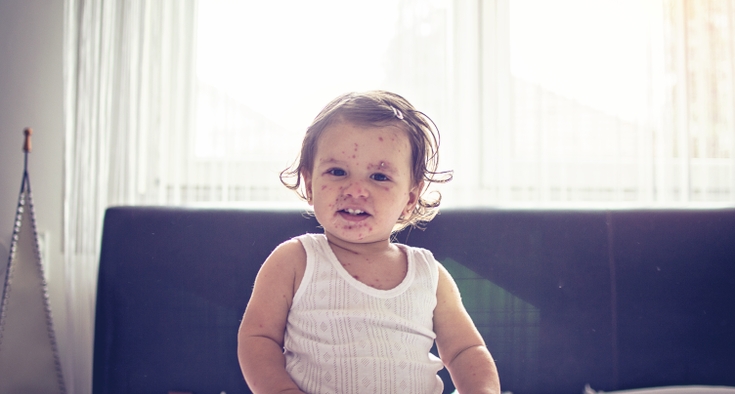 What’s it like to get measles? That depends.