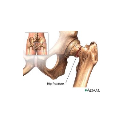 Researchers Detail How Aging Undermines Bone Healing