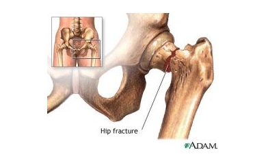 Researchers Detail How Aging Undermines Bone Healing