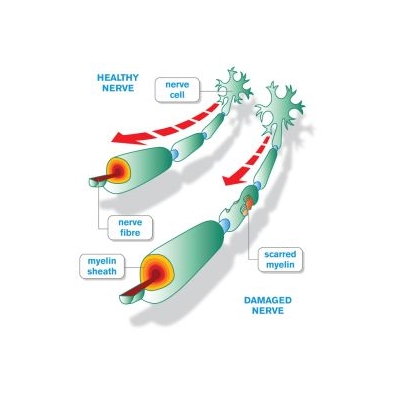 Drug Improves Mobility for Some MS Patients