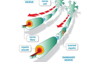 Drug Improves Mobility for Some MS Patients