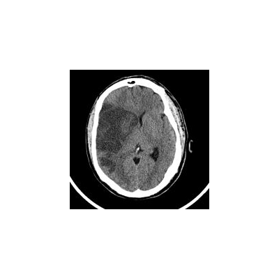 Weighing the Options after Life-Altering Stroke