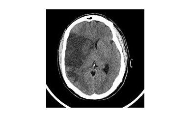 Weighing the Options after Life-Altering Stroke