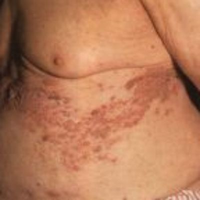 Study Assesses Relief Options Against Shingles Pain
