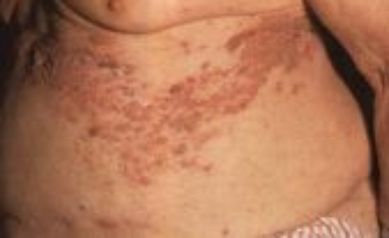 Study Assesses Relief Options Against Shingles Pain