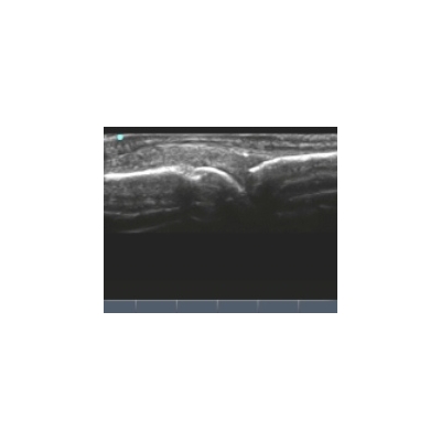 Ultrasound Saves Money, Improves Rheumatologic Care