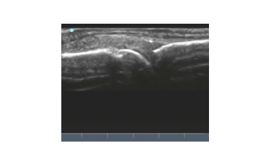 Ultrasound Saves Money, Improves Rheumatologic Care
