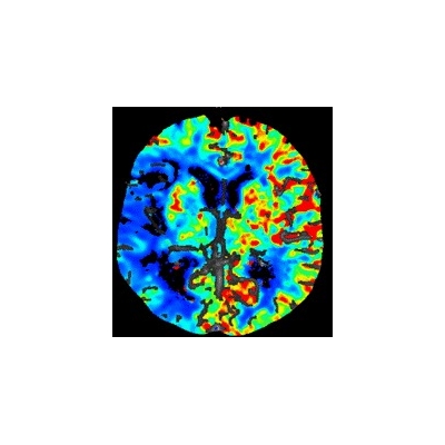 CT%20Perfusion