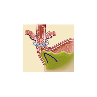 URMC to Trial Minimally Invasive Device that ‘Reins in’ Acid Reflux