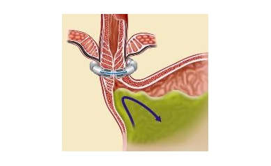 URMC to Trial Minimally Invasive Device that ‘Reins in’ Acid Reflux