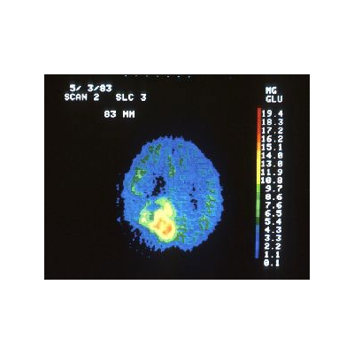 3 Events Offer Hope for People with Brain Tumors