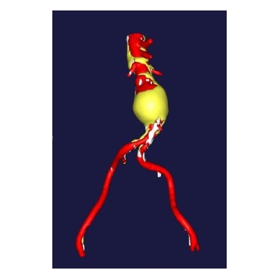Study in Nature Medicine Establishes Major New Treatment Target in Diseased Arteries