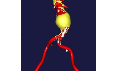 Study in Nature Medicine Establishes Major New Treatment Target in Diseased Arteries