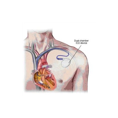 ICDs Extend the Lives of Heart Attack Survivors by a Year: Study