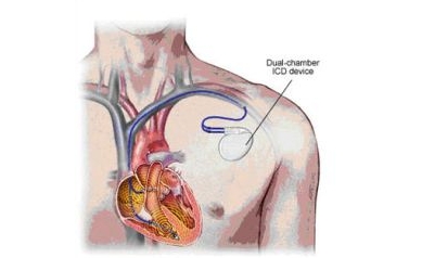 ICDs Extend the Lives of Heart Attack Survivors by a Year: Study