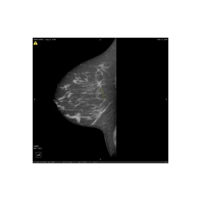 HRT-Breast Cancer Risk Stays Same, Regardless of Family History