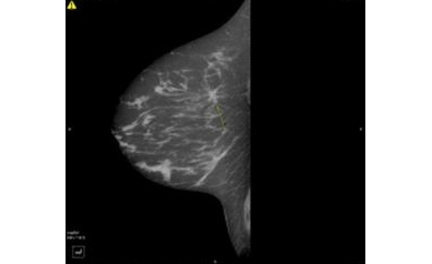 HRT-Breast Cancer Risk Stays Same, Regardless of Family History