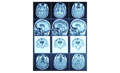 July 23-25 Garage Sale Benefits Wilmot Cancer Center Brain Tumor Research
