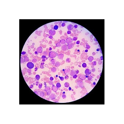 Gene Study Points Researchers toward New Pathway for Leukemia