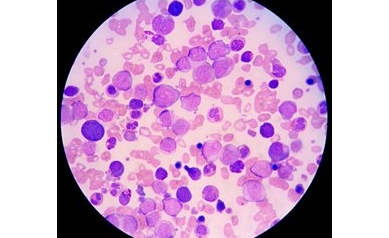 Gene Study Points Researchers toward New Pathway for Leukemia