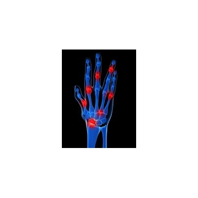 CTSI Incubator Fosters Collaboration on Treatment Targets, Biomarkers for Psoriatic Arthritis