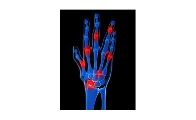 CTSI Incubator Fosters Collaboration on Treatment Targets, Biomarkers for Psoriatic Arthritis