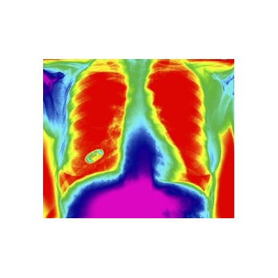 Pushing Personalized Therapy for Lung Cancer