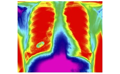 Pushing Personalized Therapy for Lung Cancer
