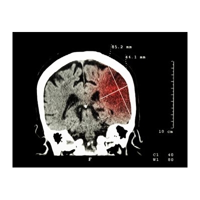 Study Establishes International Standards for Stroke Outcomes