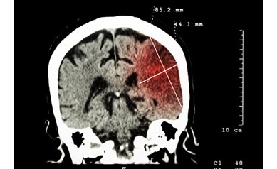 Study Establishes International Standards for Stroke Outcomes